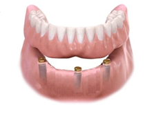 Lower Implant OverDenture Sun City West 3 Implants | Geneva Dental Group | Dentures in Sun City West