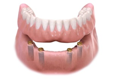 Lower Implant OverDenture Sun City West 4 Implants | Geneva Dental Group | Dentures in Sun City West