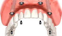 Permanently Fixed Dental Bridge Sun City West | Geneva Dental Group