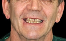 Tooth Extraction Sun City West | Geneva Dental Group | Patient 1 Before