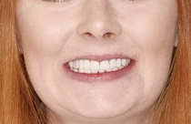 Tooth Extraction Sun City West | Geneva Dental Group | Patient 2 After