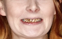 Tooth Extraction Sun City West | Geneva Dental Group | Patient 2 Before