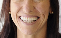 Tooth Extraction Sun City West | Geneva Dental Group | Patient 3 After