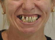 Tooth Extraction Sun City West | Geneva Dental Group | Patient 3 Before