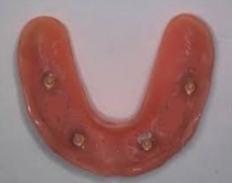 Upper Implant OverDenture Sun City West 4 Implants | Geneva Dental Group | Dentures Sun City West