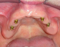 Upper Implant OverDenture Sun City West 4 Implants | Geneva Dental Group | Dentures in Sun City West