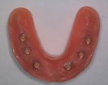 Upper Implant OverDenture Sun City West 6 Implants | Geneva Dental Group | Dentures Sun City West
