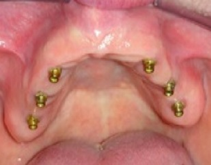 Upper Implant OverDenture Sun City West 6 Implants | Geneva Dental Group | Dentures in Sun City West